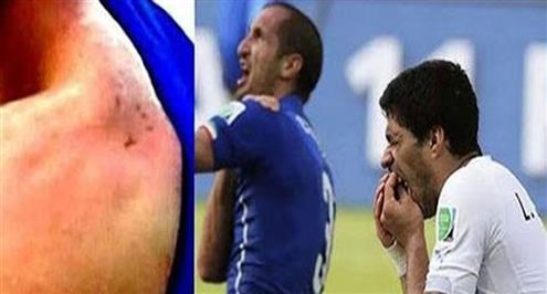 #يلا_كوبا .. "عضة" تغيب سواريز والإصابات تضرب كوبا أمريكا بقوة 